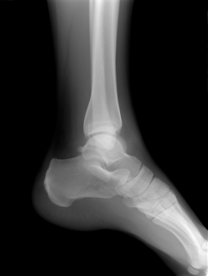 An X-ray will diagnose a stress fracture